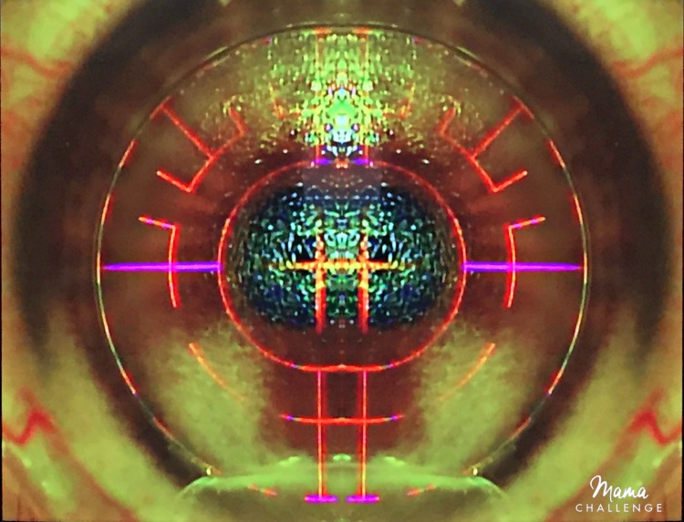 Lasik Eye Procedure at Kleiman Evangelista