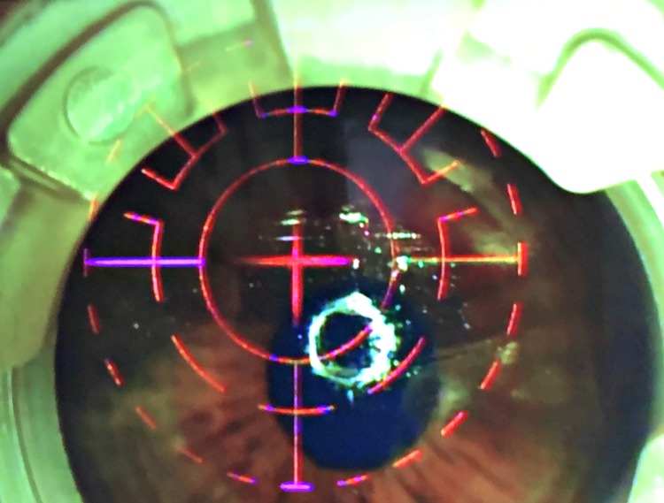 Lasik Eye Procedure at Kleiman Evangelista