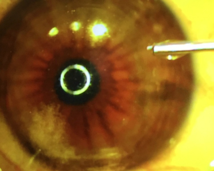 Lasik Eye Procedure at Kleiman Evangelista