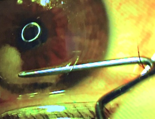 Lasik Eye Procedure at Kleiman Evangelista
